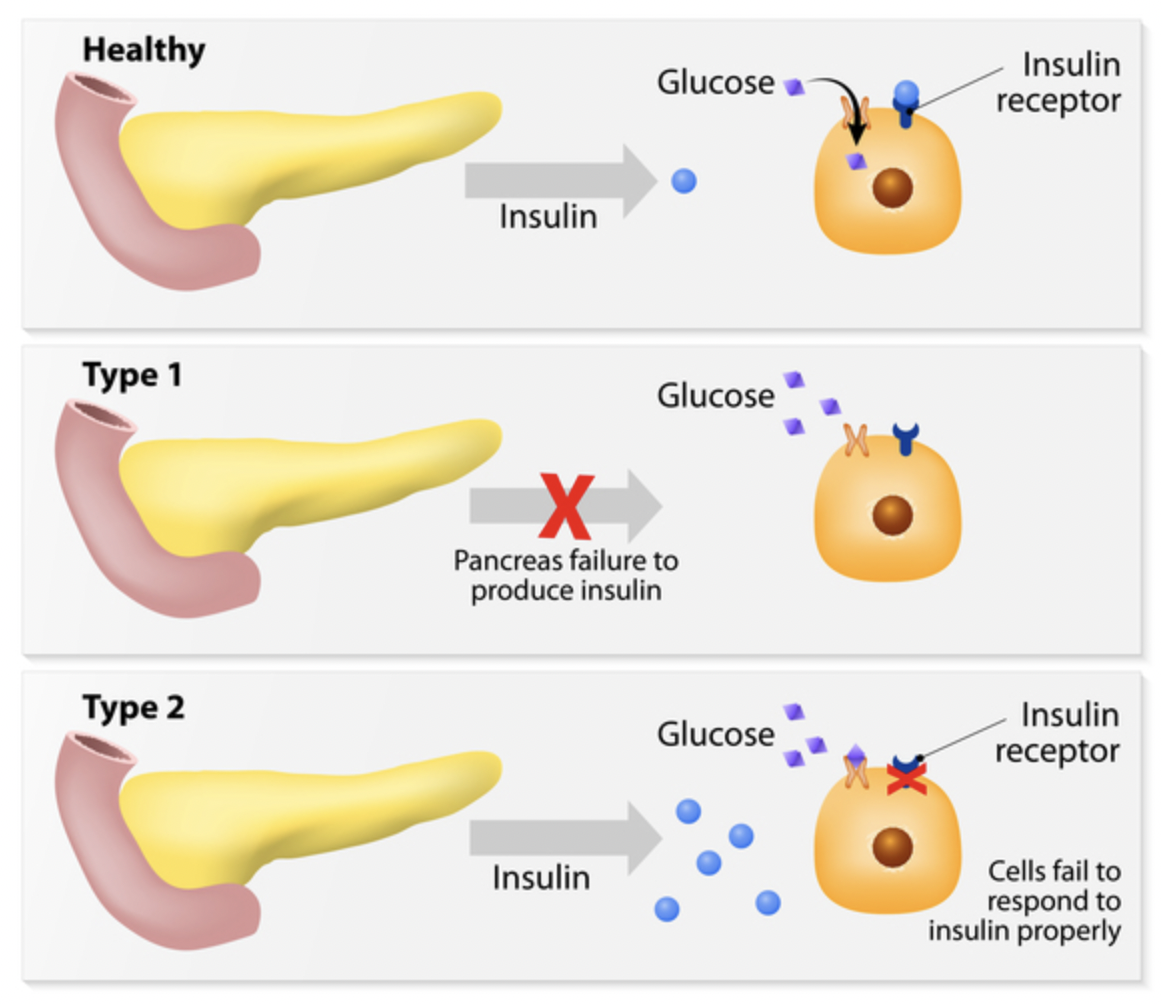 Diabetes Types|Source: MedlinePlus